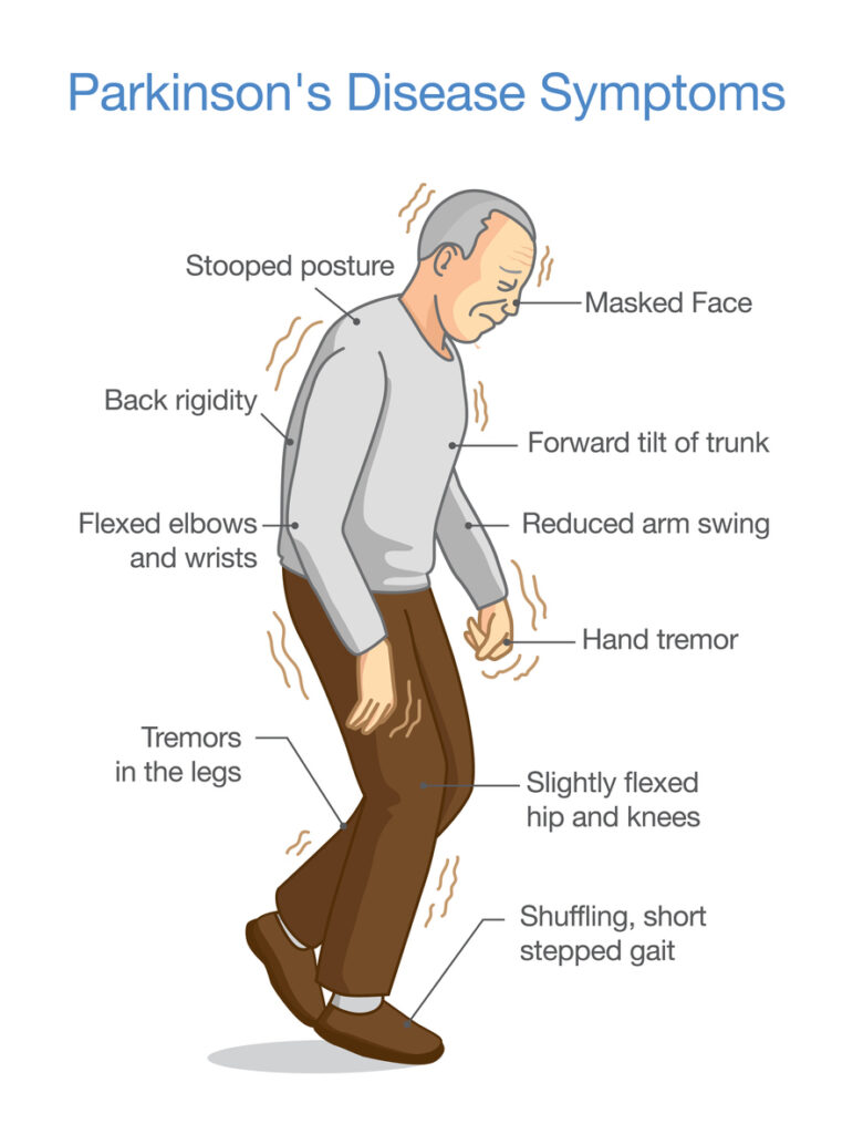 Symptoms of Parkinsons disease